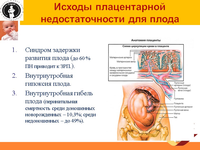 Исходы плацентарной недостаточности для плода  Синдром задержки развития плода (до 60 % ПН